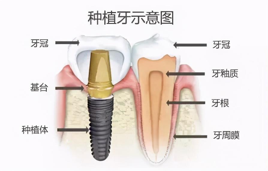 种植牙领域最新动态与进展报告